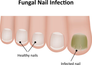 Healthy and Unhealthy Fungal Nail Infection | Healthier Me Today