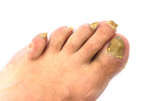 Fungal Nail Infection | Healthier Me Today