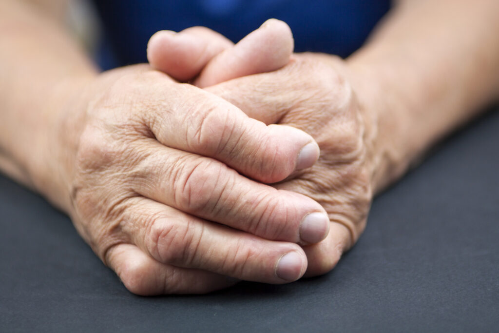 Hands Of Woman Deformed From Rheumatoid Arthritis | Healthier Me Today