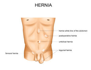 types of hernias by location | Healthier Me Today