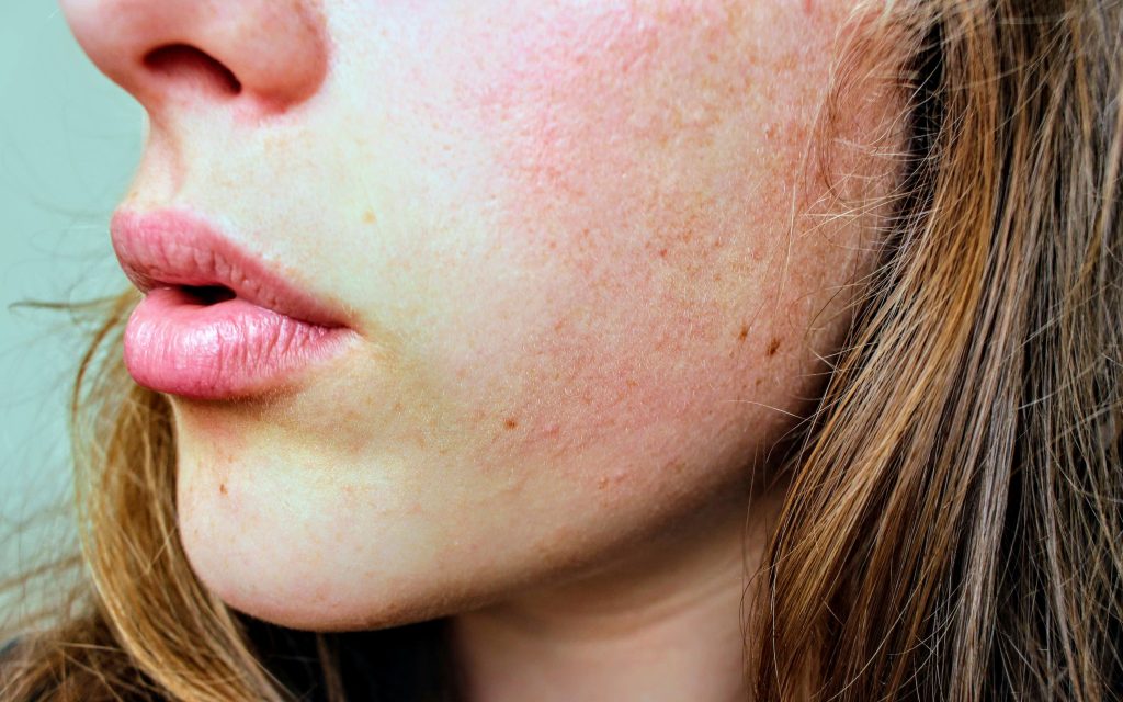 close shot of woman's face, dry skin type // Healthier Me Today