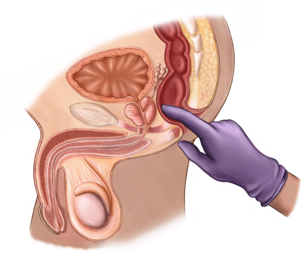 rectal exam, shrink your prostate in a matter of seconds // Healthier Me Today