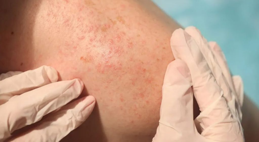 hepatitis c symptoms