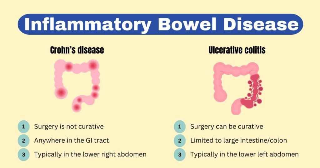 inflammatory bowel disease
