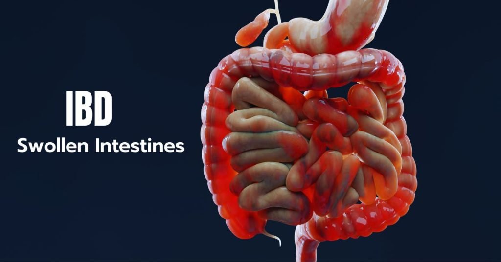 inflammatory bowel disease