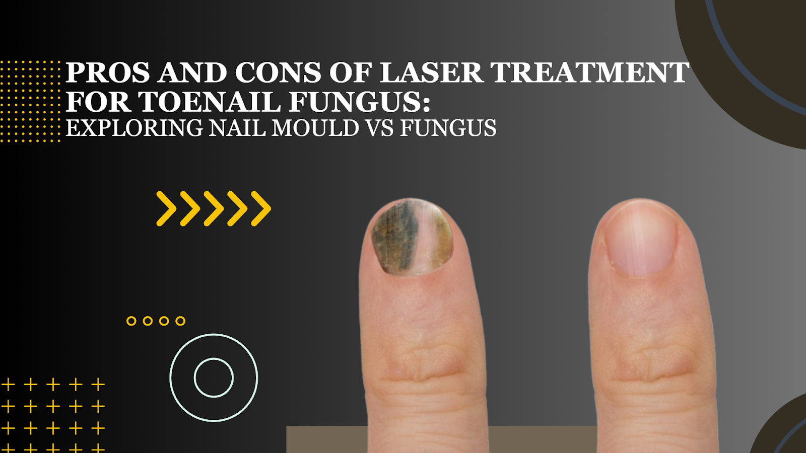 Laser Treatment for Toenail Fungus