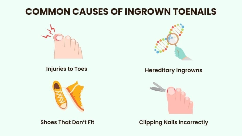 what causes ingrown toenails