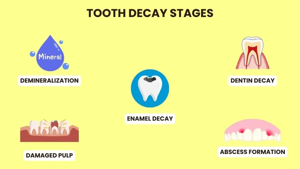 tooth decay stages