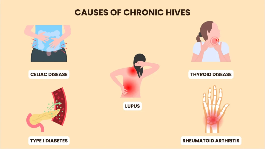 Causes of Chronic Hives 