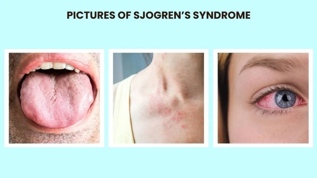 Sjogren’s Syndrome