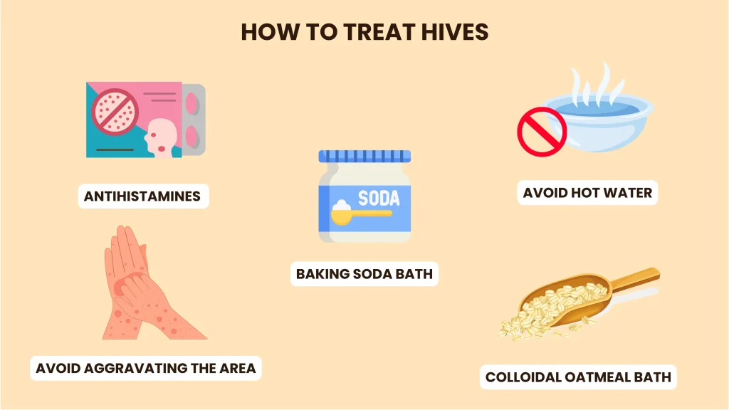 How to treat hives