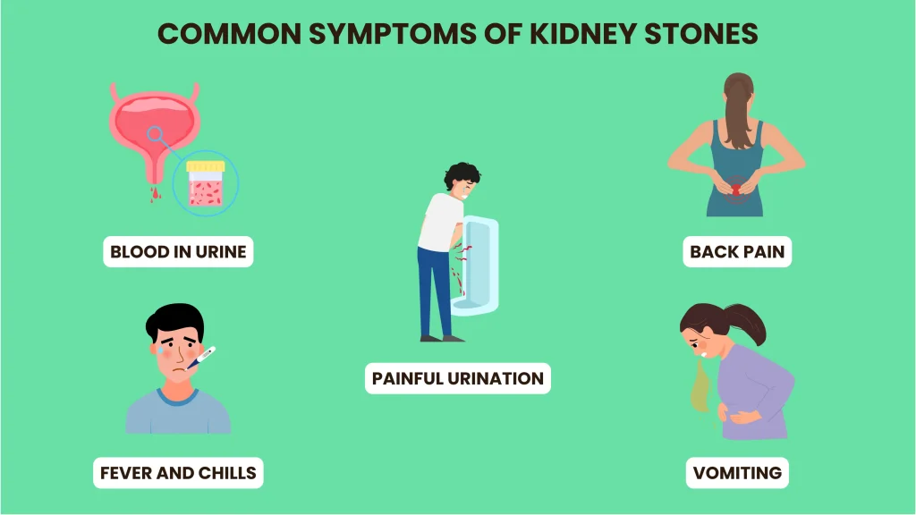 kidney stone symptoms