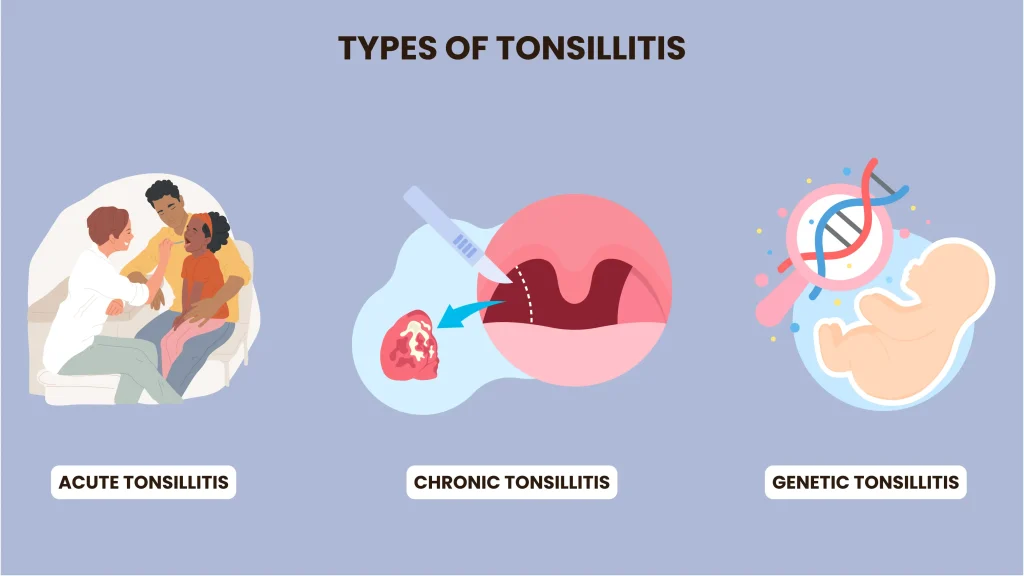 types of tonsillitis