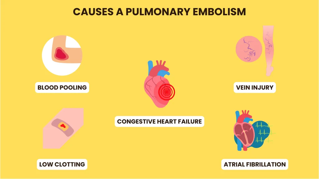 Causes of Pulmonary Embolism