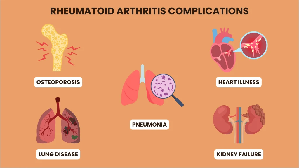 Rheumatoid Arthritis Complications