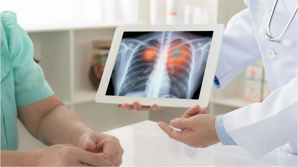 tobacco use and lung cancer