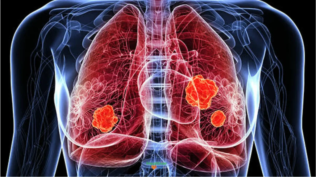Lung Cancer Awareness Month 2024