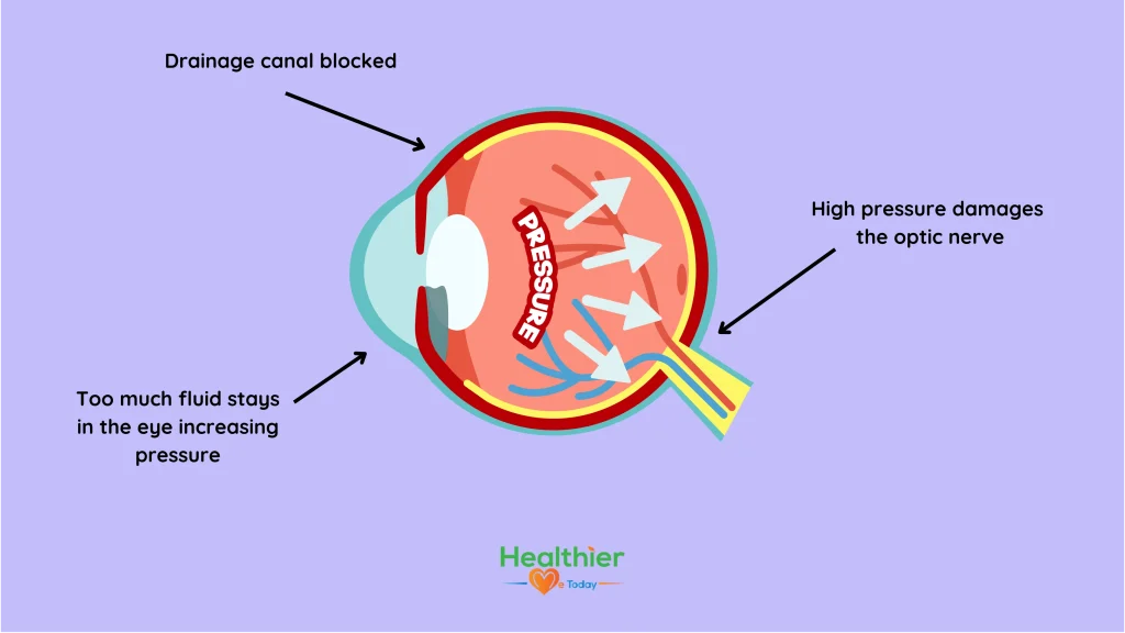glaucoma symptoms