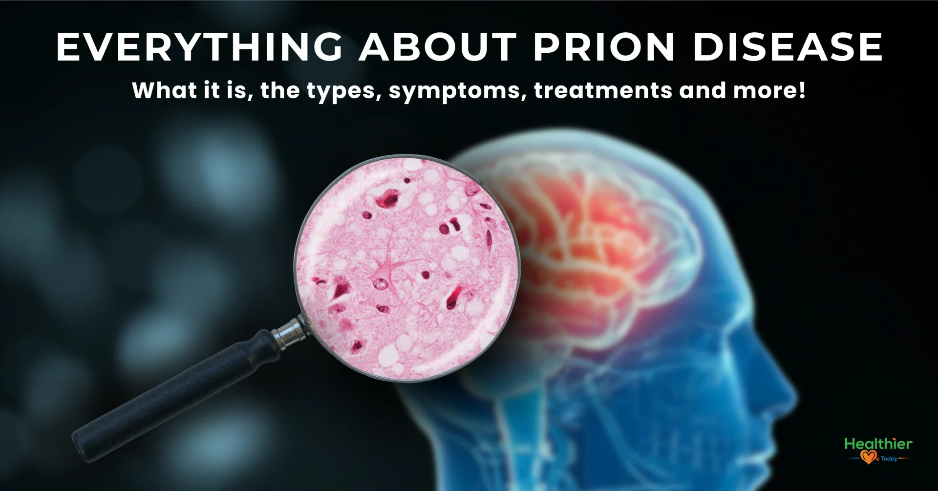 prion disease