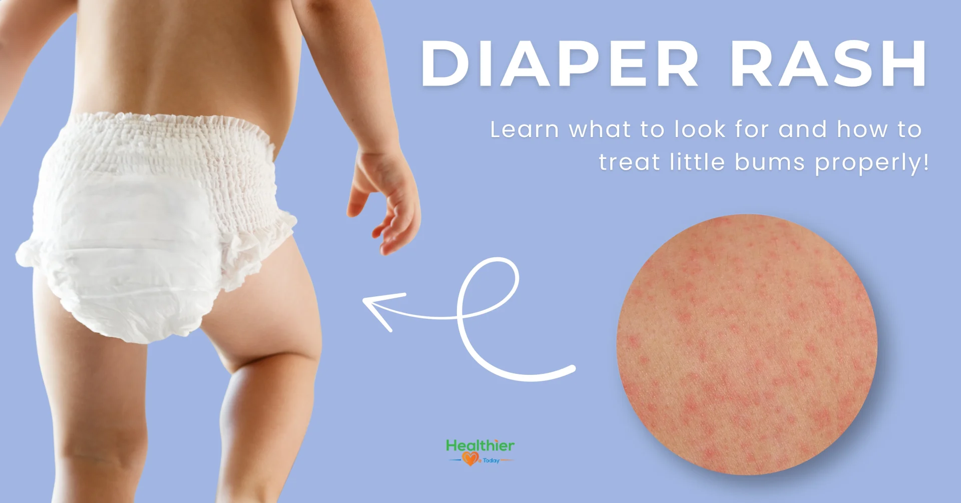 diaper rash treatment